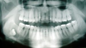 800px-Cyst_-_wisdom_tooth